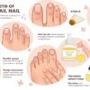 Fungal Nail Infections by beautyoura